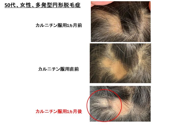 円形脱毛症　病院